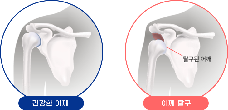 어깨 탈구 대표이미지