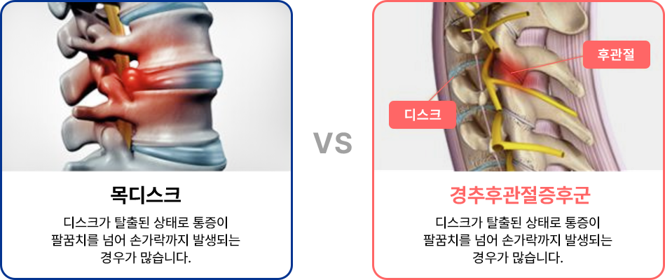 경추후관절증후군 대표이미지