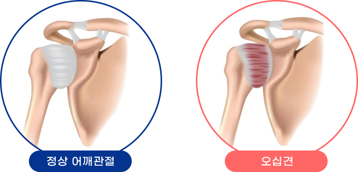 오십견 대표이미지