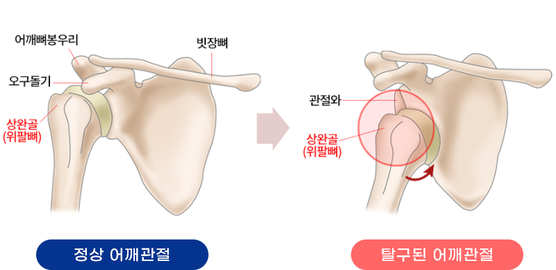 재발성 견관절 탈구 대표이미지