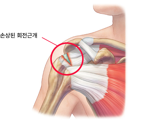 회전근개파열 대표이미지