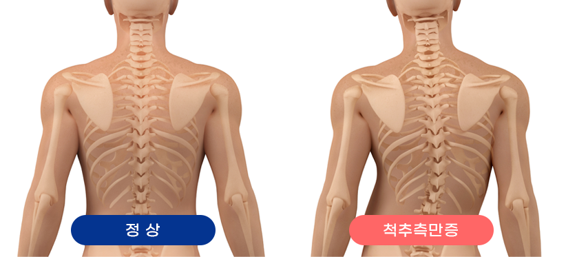 척추측만증 대표이미지