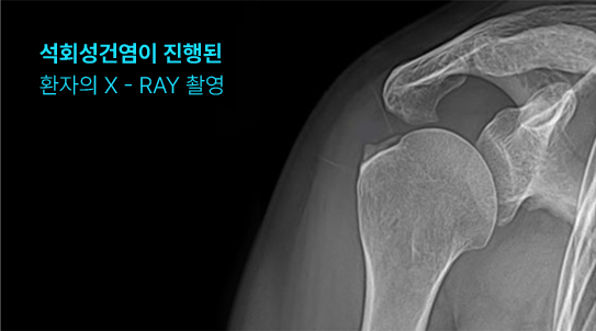 석회성건염이 진행된 환자의 X-ray 촬영