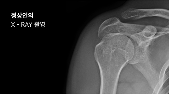 정상인의 X-ray 촬영