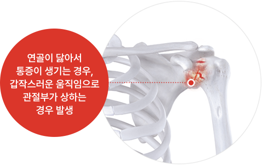 연골이 닳아서 통증이 생기는 경우, 갑작스러운 움직임으로 관절부가 상하는 경우 발생