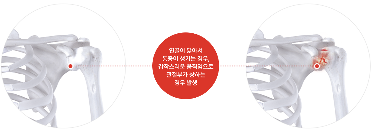 연골이 닳아서 통증이 생기는 경우, 갑작스러운 움직임으로 관절부가 상하는 경우 발생