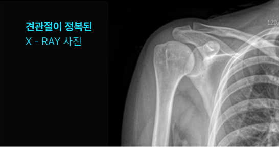 견관절이 정복된 X-ray 사진