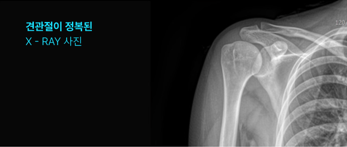 견관절이 정복된 X-ray 사진