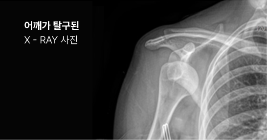어깨가 탈구된 X-ray 사진