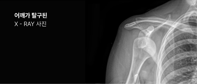 어깨가 탈구된 X-ray 사진