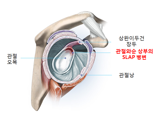 상부관절와순파열 대표이미지