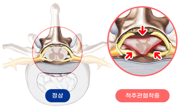 척추관협착증 대표이미지