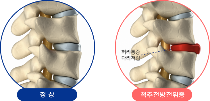 척추전방전위증 대표이미지