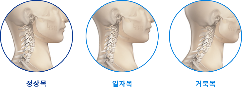 일자목 · 거북목 대표이미지