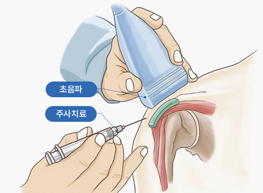 초음파 주사치료 대표이미지