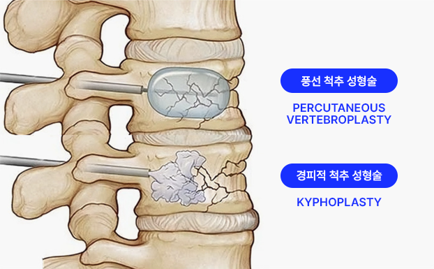 20~40도 측만증 : 도수치료, 운동 교육 등 비수술적 치료 가능