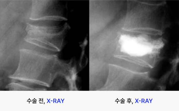 40도 이상 측만증 : 심화단계로 수술척 치료가 필요